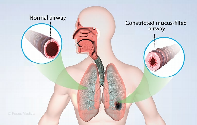 asthma diagram